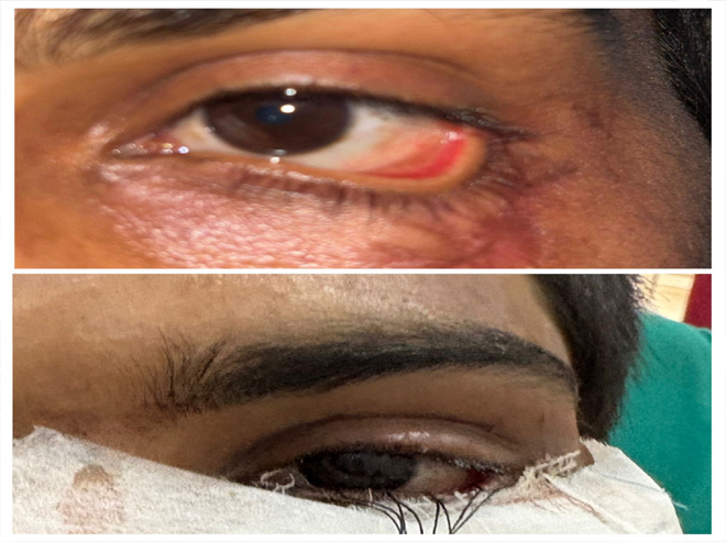 स्किन ग्राफ्टिंग से मरीज के पलक का सफल पुनर्निर्माण, युवक को नई दृष्टि और सामान्य जीवन की ओर लौटने का मिला अवसर