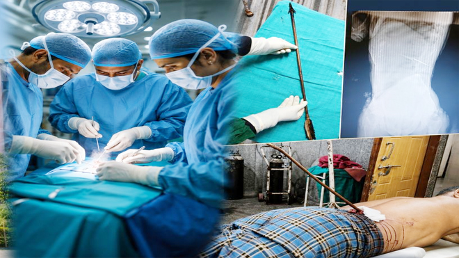 आंबेडकर अस्पताल के डॉक्टरों ने किया कमाल : पीठ में धंसे तीर से गंभीर रूप से घायल मरीज का सफल ऑपरेशन, बचाई जान